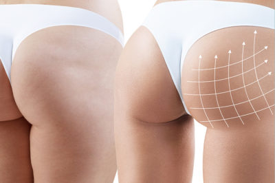filler corpo glutei