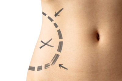 liposcultura chirurgia rimodellamento corpo